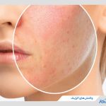 واکنش آلرژیک چیست و چطور کنترل می‌شود؟