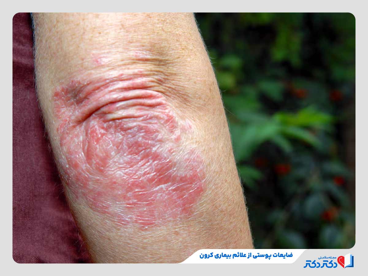 زن دچار به ضایعات پوستی به دلیل ابتلا به بیماری کرون
