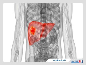 سرطان کبد چیست؟ بررسی عوامل مهم ایجاد این بیماری و درمان قطعی آن