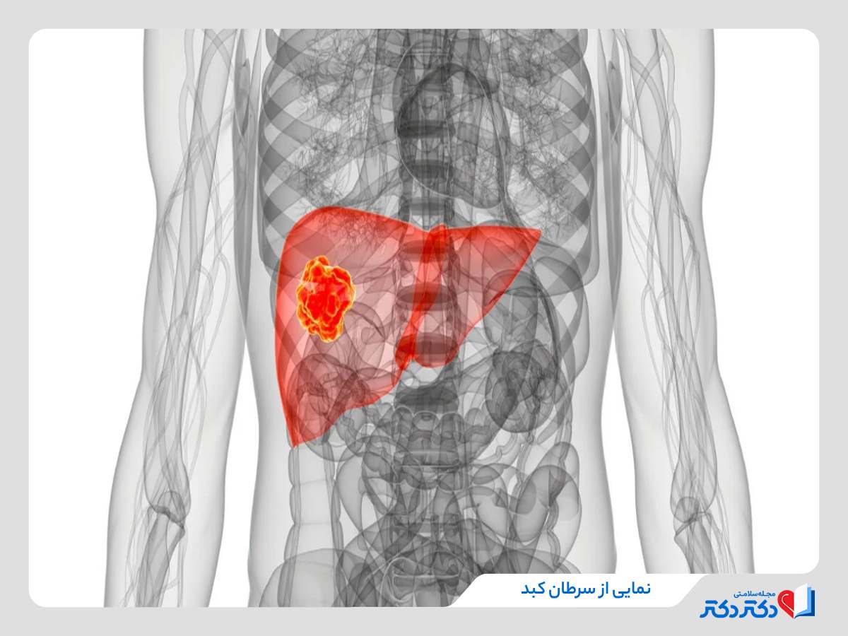 اثرات سرطان کبد روی این عضو مهم
