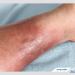 سلولیت پوستی چیست و چگونه ایجاد می‌شود؟