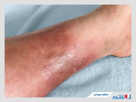 سلولیت پوستی چیست و چگونه ایجاد می‌شود؟