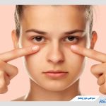 سیاهی دور چشم چیست و چطور درمان می‌شود؟