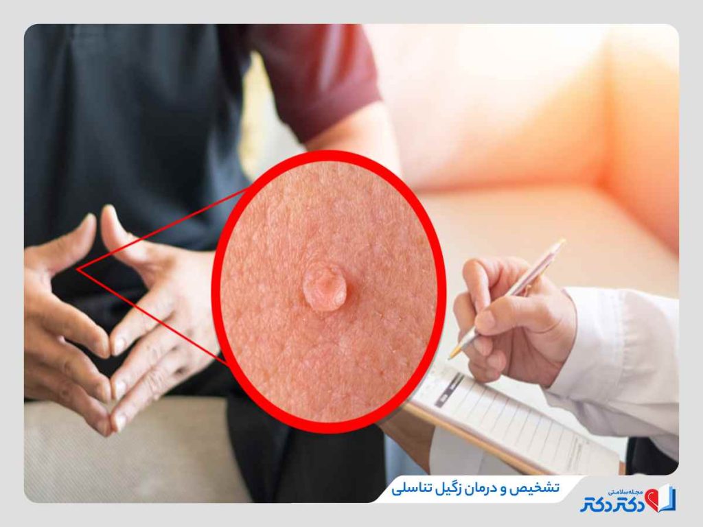 زگیل تناسلی