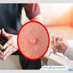 زگیل تناسلی چیست؟ بررسی کامل و پاسخ به سوالات متداول درباره این بیماری