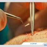 فولیکول مو چیست و چرا نقش حیاتی در رشد و ریزش مو دارد؟