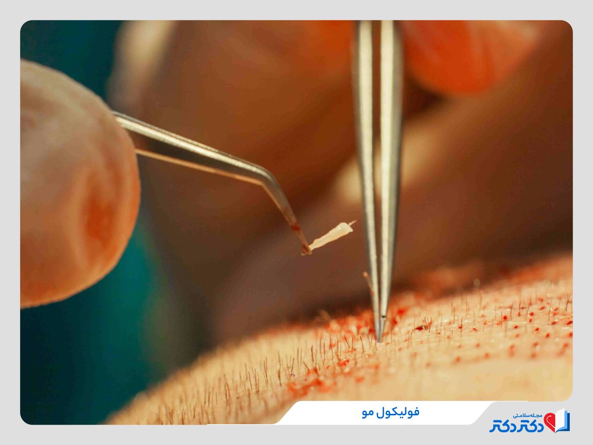 فولیکول مو چیست و چرا نقش حیاتی در رشد و ریزش مو دارد؟