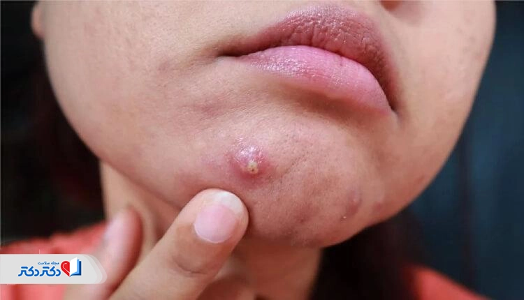 انواع جوش پریودی