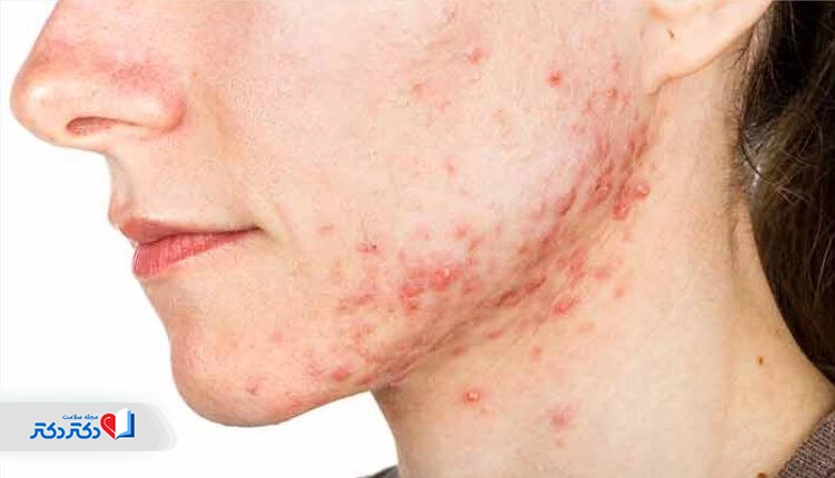 آکنه کیستیک شکل شدیدی از جوش پریودی