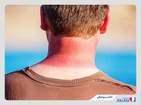 همه چیز درباره آفتاب‌ سوختگی؛ از راه‌های مقابله تا درمان