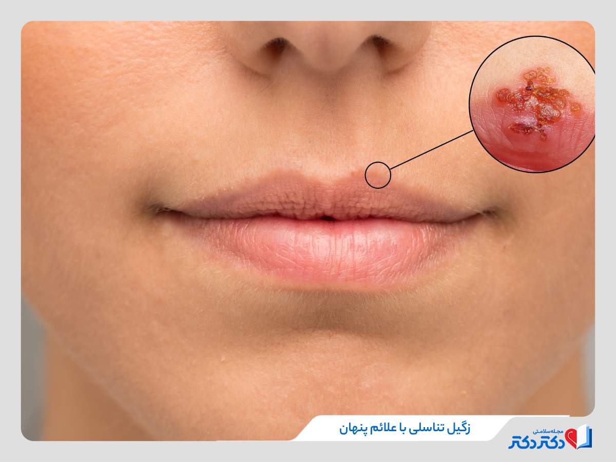 بوسیدن یکی از راه های انتقال زگیل تناسلی