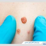 راه‌ های انتقال زگیل تناسلی؛ آنچه که مهم است و باید بدانید!