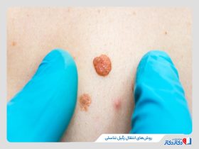 راه‌ های انتقال زگیل تناسلی؛ آنچه که مهم است و باید بدانید!
