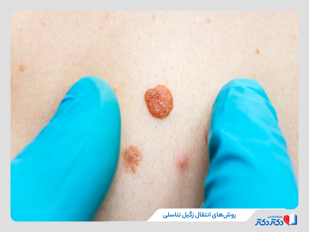 راه های انتقال زگیل تناسلی
