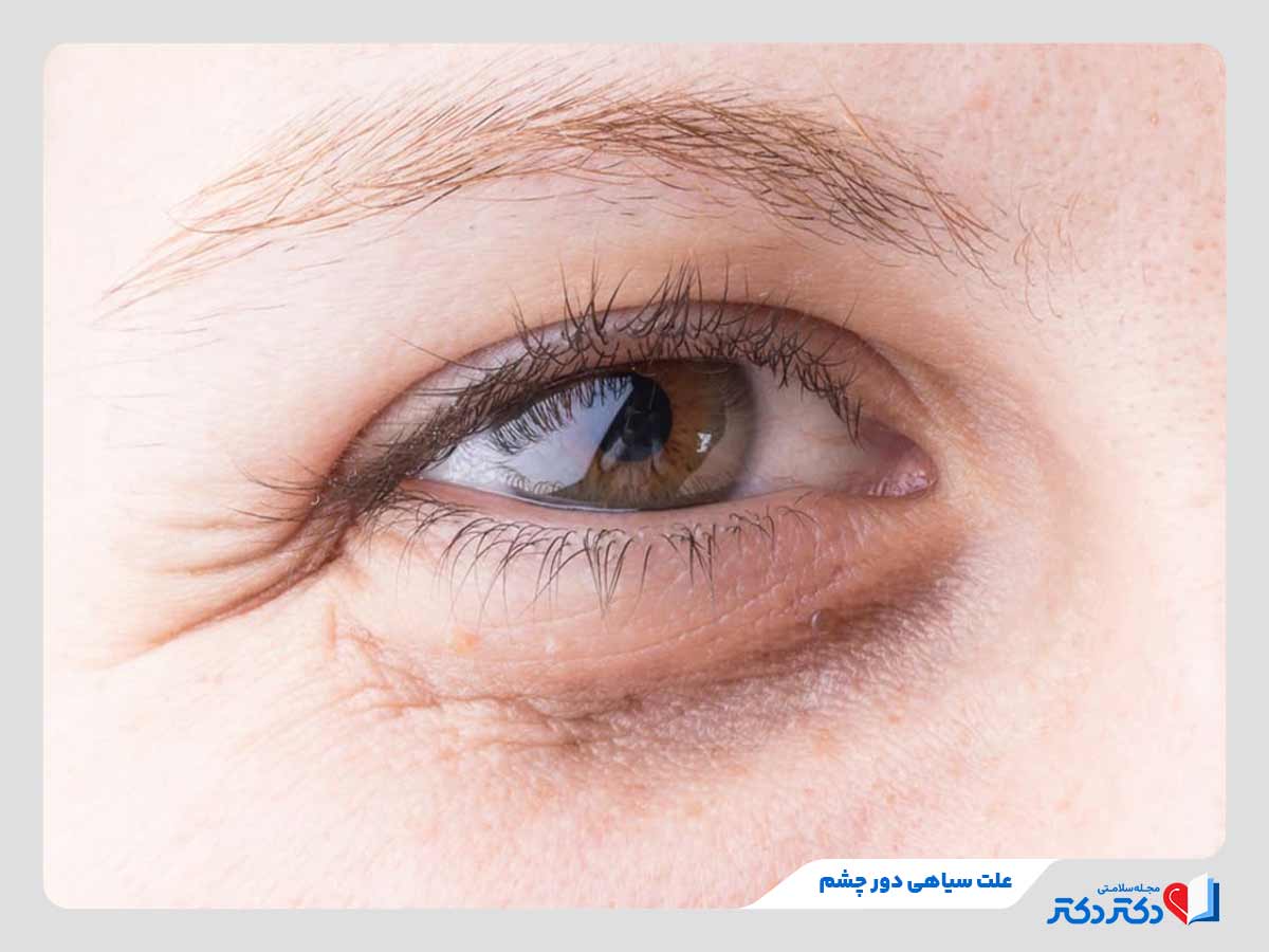 فرد مبتلا به سیاهی دور چشم در اثر کم‌خوابی و خستگی