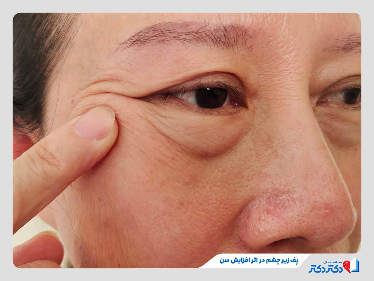 زن مبتلا به پف زیر چشم در اثر افزایش سن