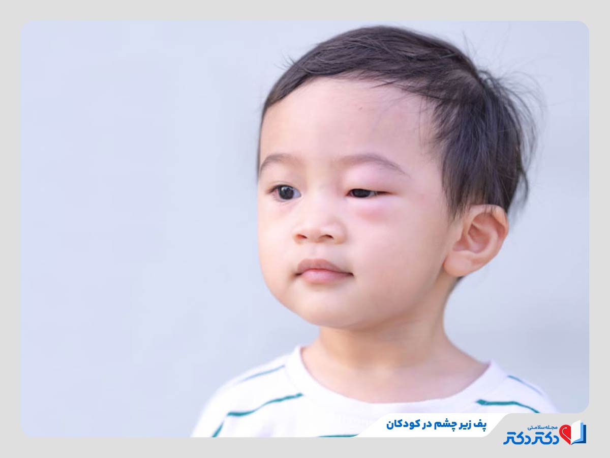 کودک مبتلا به پف زیر چشم