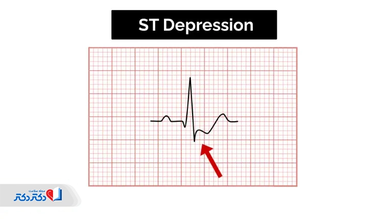 قطعه ST پایین