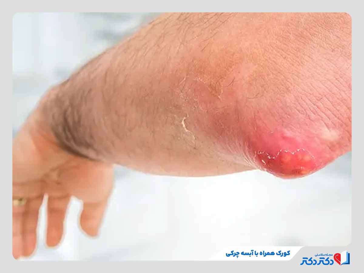 فرد مبتلا به کورک پوستی یا دمل همراه با آبسه چرکی