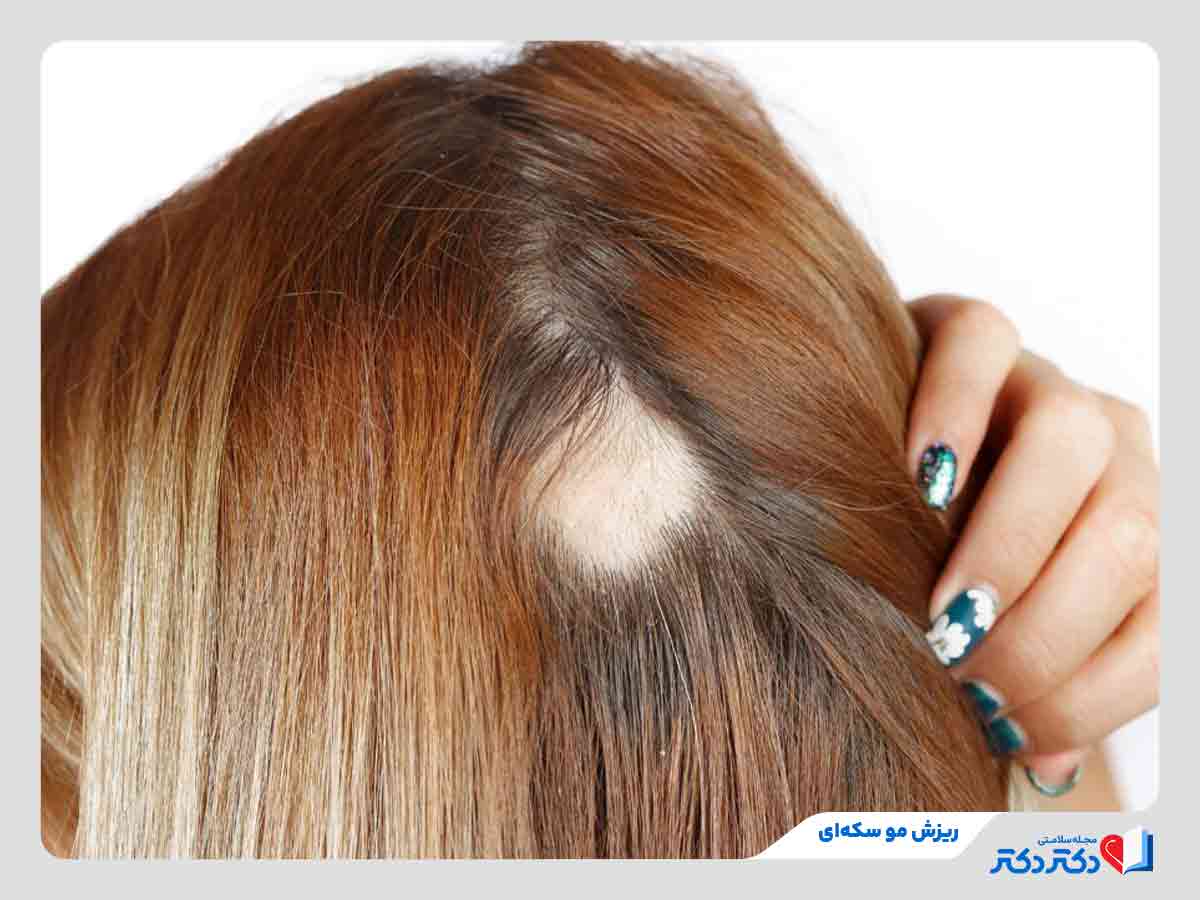 زن مبتلا به ریزش مو سکه ای