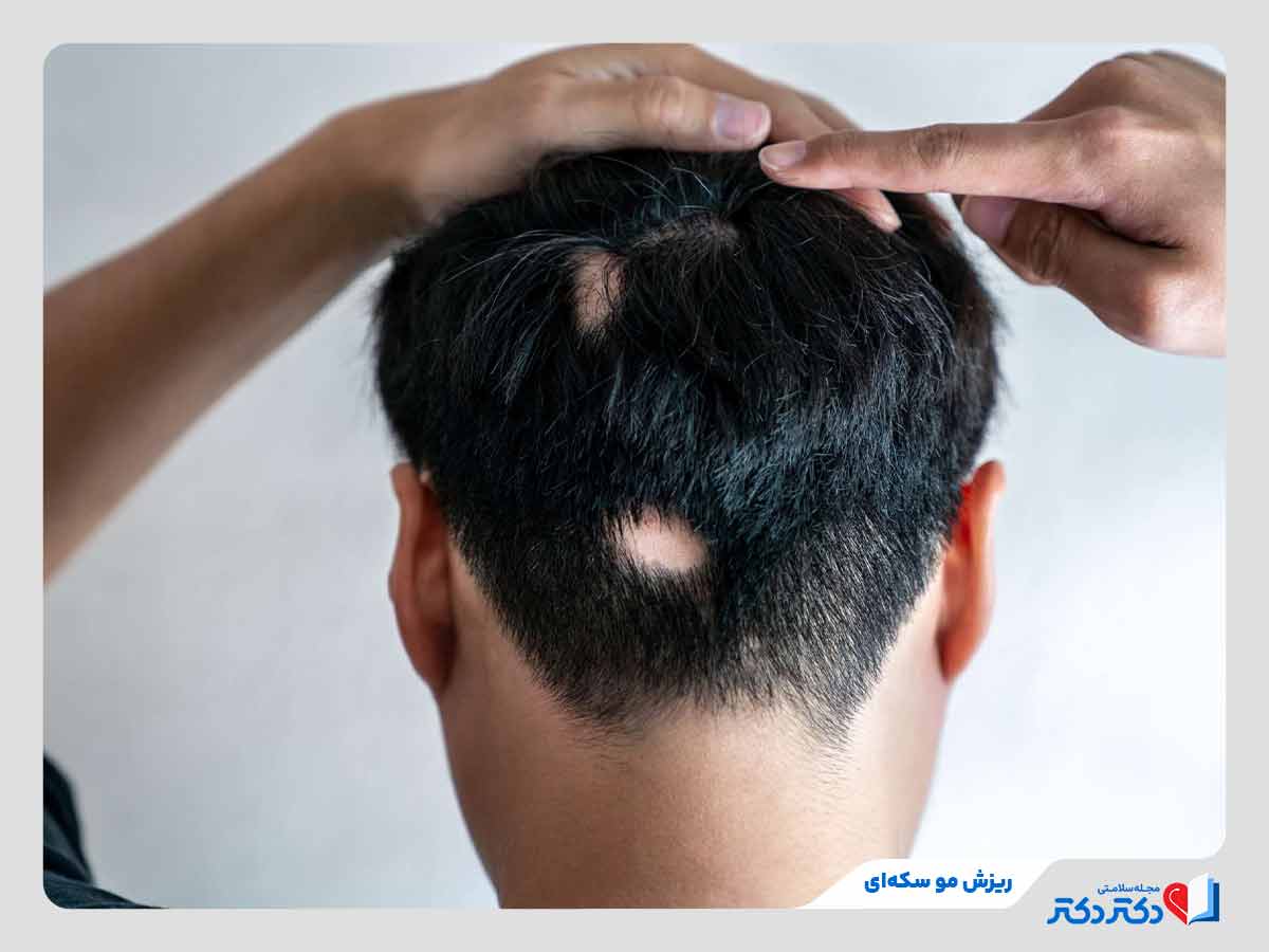 فرد مبتلا به کچلی سکه ای در اثر کمبود ویتامین دی و ریزش مو