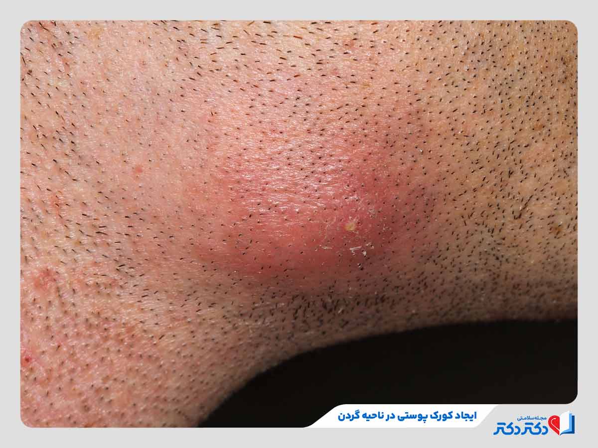 ظهور کورک پوستی در ناحیه گردن