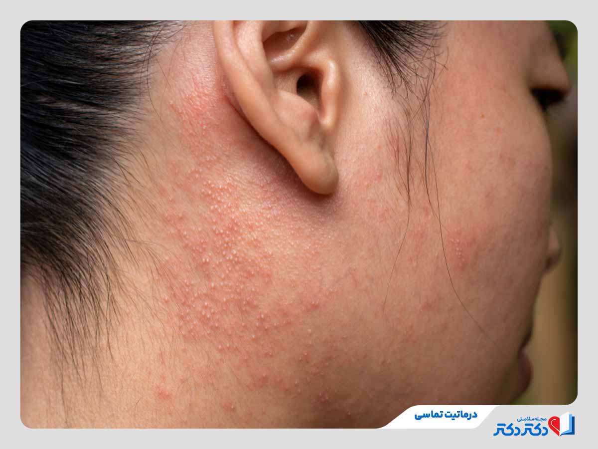 زن مبتلا به درماتیت تماسی در ناحیه گردن