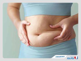 شکم کورتیزولی چیست و چگونه درمان می‌شود؟
