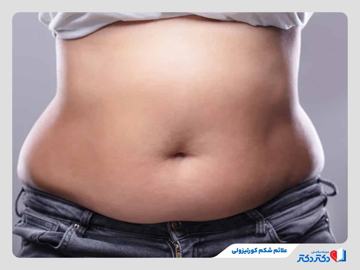 چربی احشایی از علائم شکم کورتیزولی