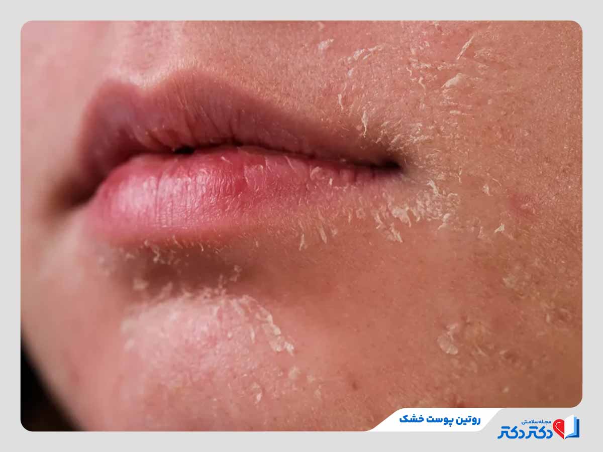 فرد مبتلا به پوست خشک و نیازمند به روتین پوست خشک