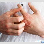 اگزما چیست؟ معرفی انواع این بیماری، علل و علائم آن