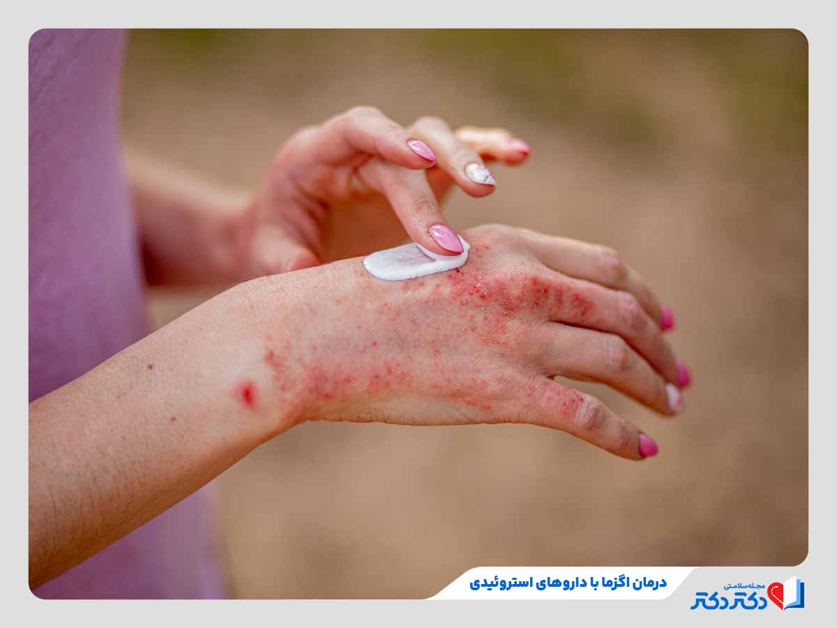 فرد در حال استفاده از کرم های استروئیدی برای درمان اگزما