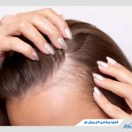 کمبود ویتامین دی و ریزش مو چه ارتباطی دارند؟