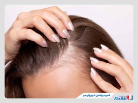 کمبود ویتامین دی و ریزش مو چه ارتباطی دارند؟