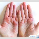 اگزمای دست چیست و چگونه درمان می‌شود؟