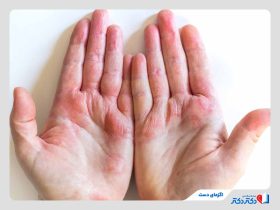 اگزمای دست چیست و چگونه درمان می‌شود؟
