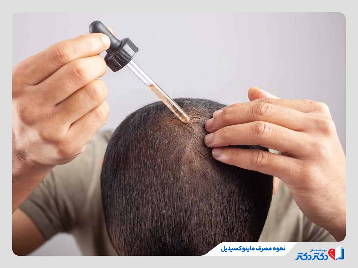 فرد در حال استفاده درست از محلول ماینوکسیدیل