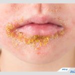 زرد زخم چیست و چگونه درمان می‌شود؟