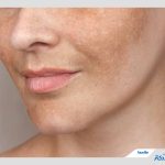 لک ملاسما چیست؟ راه‌های درمان این لکه‌های سخت
