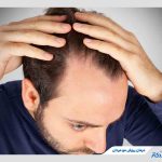 بهترین روش‌های درمان ریزش مو مردان؛ راهنمای کامل از دارو درمانی تا مزوتراپی