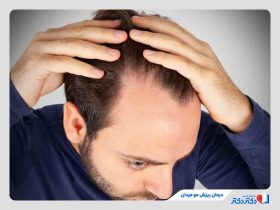 بهترین روش‌های درمان ریزش مو مردان؛ راهنمای کامل از دارو درمانی تا مزوتراپی