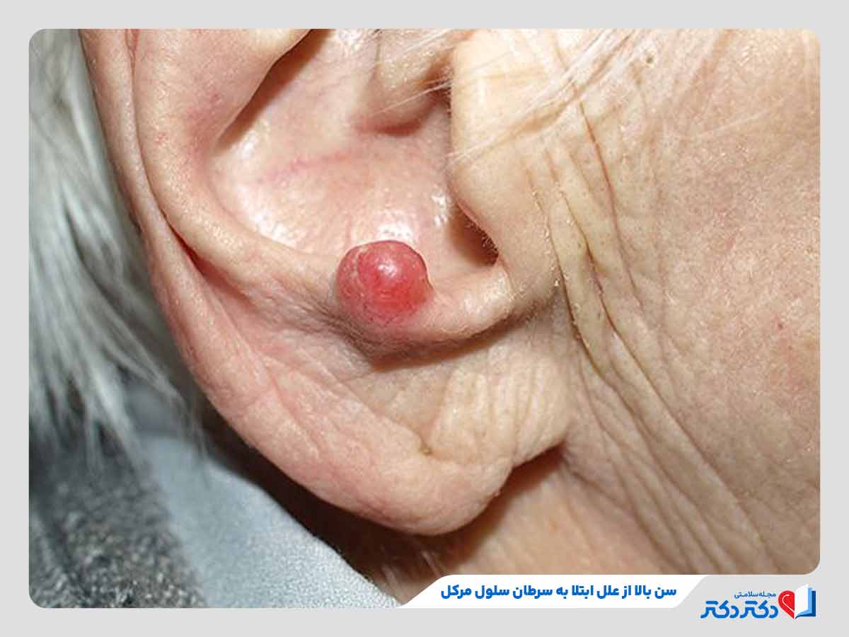 فرد مبتلا به سلول مرکل پوست در سن بالا