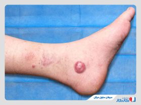 سرطان سلول مرکل چیست؟ چرا به کارسینوم آن مبتلا می‌شویم؟