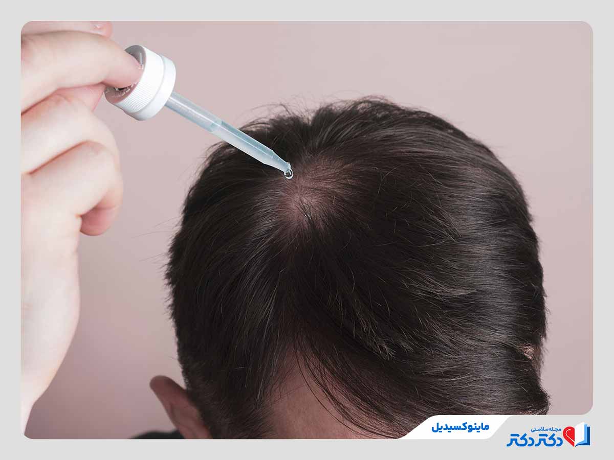 فرد در حال استفاده از محلول ماینوکسیدیل