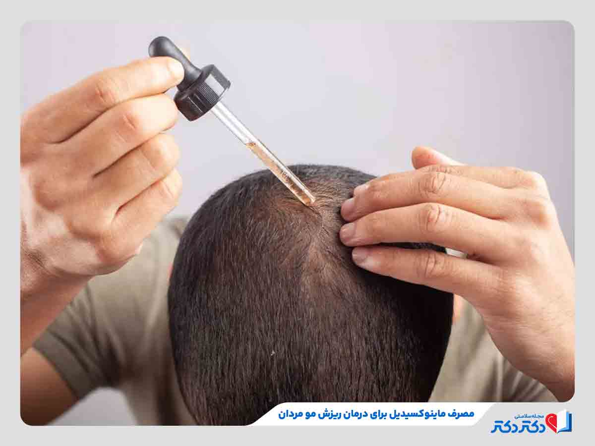 فرد در حال استفاده از ماینوکسیدیل برای درمان ریزش مو مردان