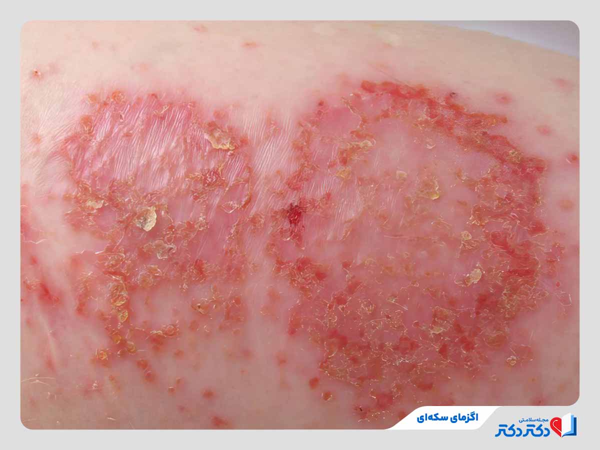 فرد مبتلا به نوعی از اگزما به نام اگزمای سکه‌ای