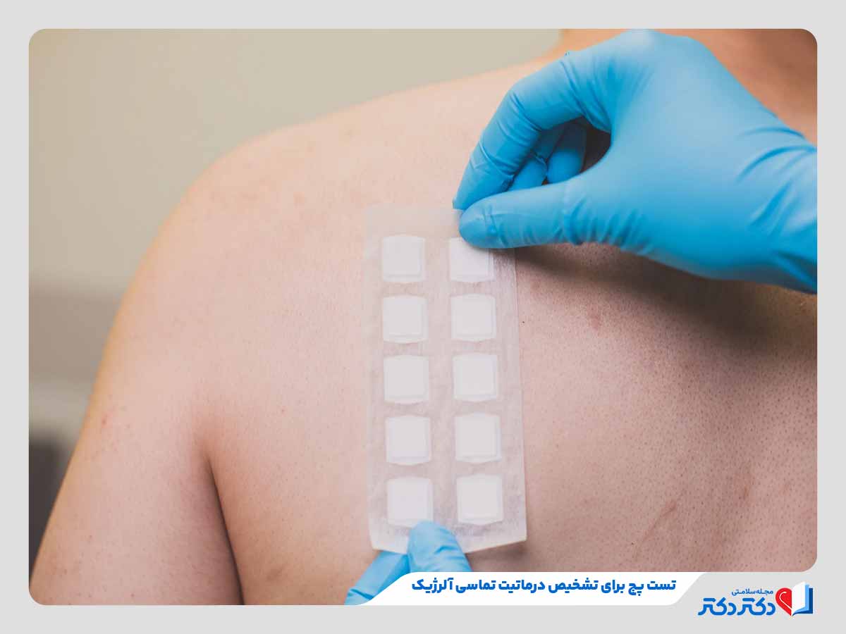 دکتر در حال انجام تست پچ برای تشخیص درماتیت تماسی آلرژیک