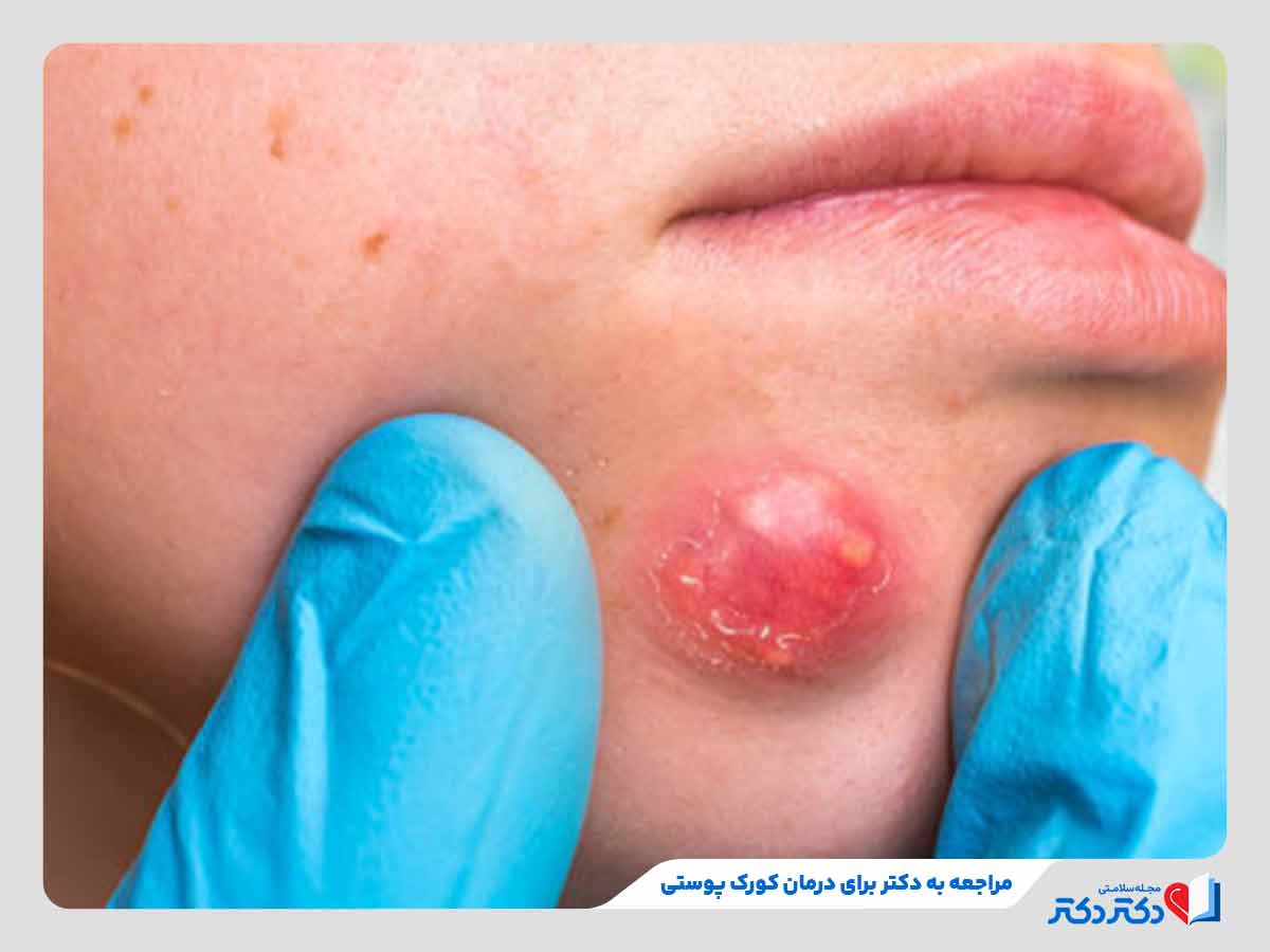دکتر در حال معاینه دمل چرکی ناحیه صورت