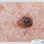 سرطان پوست چیست؟ شناخت کامل علل، علائم و روش‌های درمان