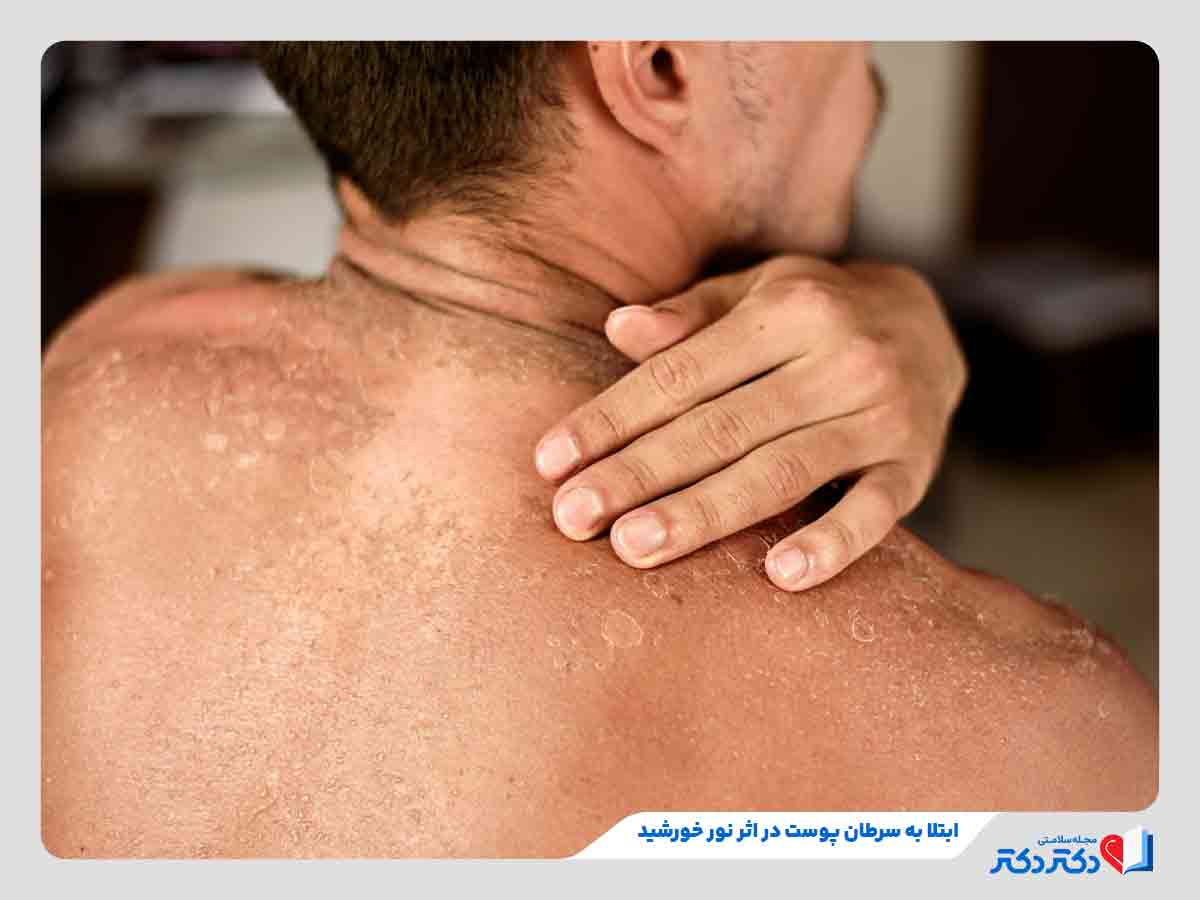 ابتلا به سرطان پوست به دلیل قرار گرفتن طولانی زیر نور خورشید